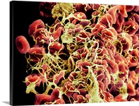 Blood clot, SEM