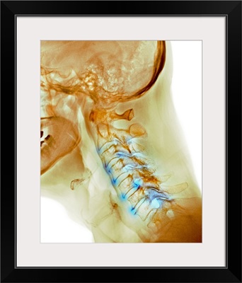 Arthritis of the neck, X-ray