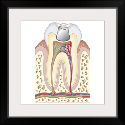 Cross section biomedical illustrationBiomedical illustration of dental filling