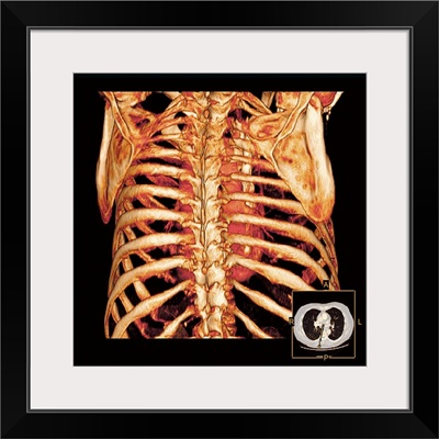 Rib cage and heart, 3D CT scan