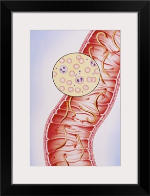 Artwork of intestinal hookworm causing anaemia