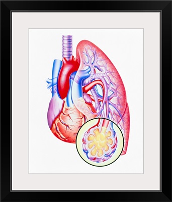 Artwork of lung oedema in heart failure