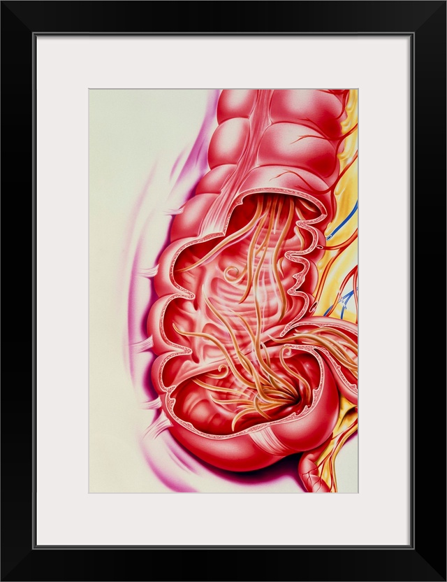 Ascaris nematode worms. Artwork of the human intestines cutaway to reveal Ascaris lumbricoides nematode worms (threadworms...