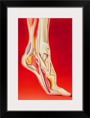 Artwork showing calcaneal spur and foot pain
