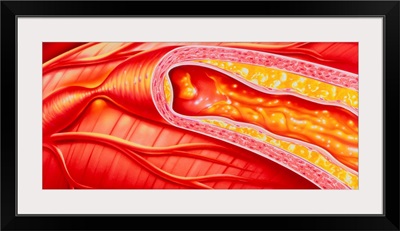 Illustration of coronary artery atherosclerosis
