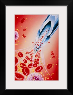 Illustration of syringe needle drawing blood lipid