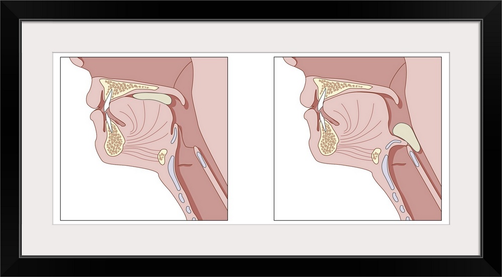 Mechanics of swallowing. Cutaway diagrams showing the process of swallowing. At left the mouthful of food (the bolus, gree...