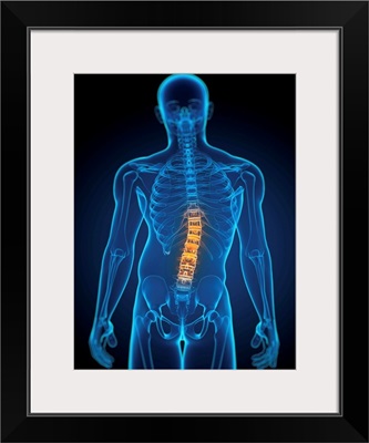 Scoliosis of the spine, artwork