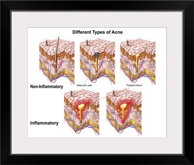 Different types of acne, non-inflammatory and inflammatory