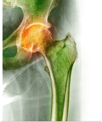 Arthritis of the hip, X-ray