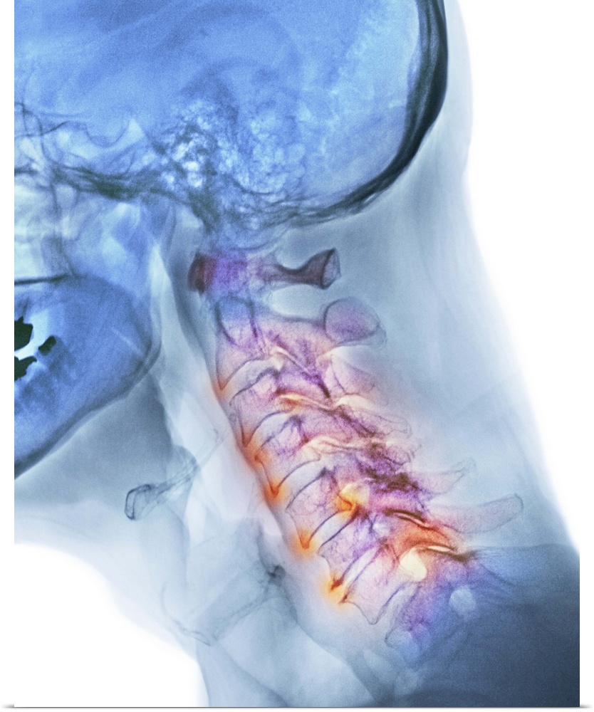 Arthritis of the neck. Coloured X-ray of the arthritic cervical spine of a 70 year old man.