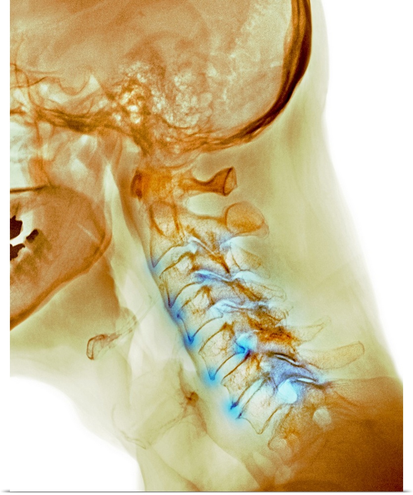 Arthritis of the neck. Coloured X-ray of the arthritic cervical spine of a 70 year old man.