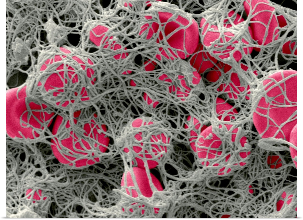 Blood clot. Coloured scanning electron micrograph (SEM) of red blood cells (erythrocytes, red) clumped together with fibri...