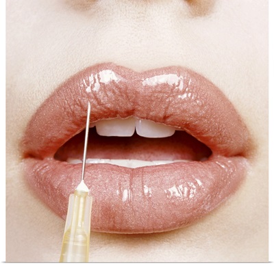 Close-up of a Woman's Lips Receiving Cosmetic Surgery from a Syringe