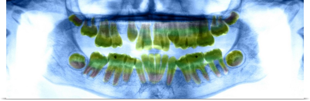 Dental X-ray showing the teeth of a 13 year old girl.