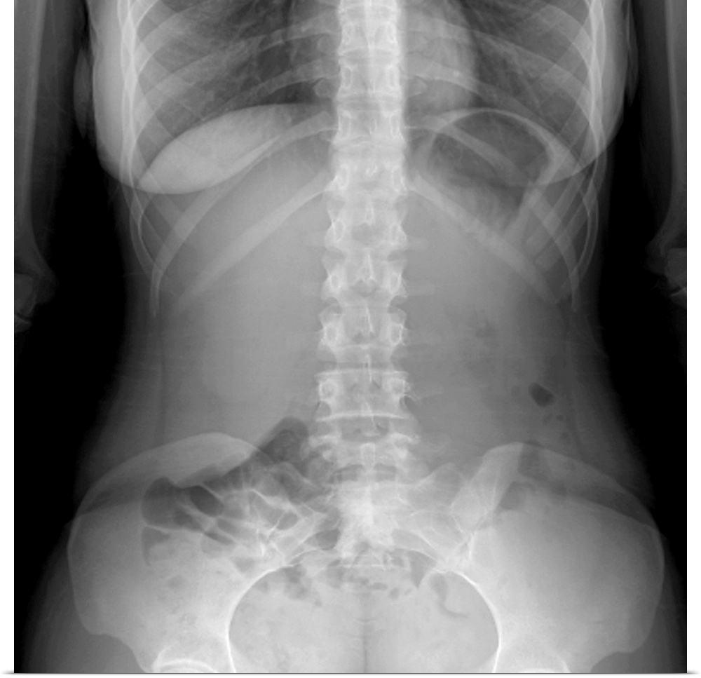 Normal abdomen. X-ray of the abdomen of a 20 year old female.