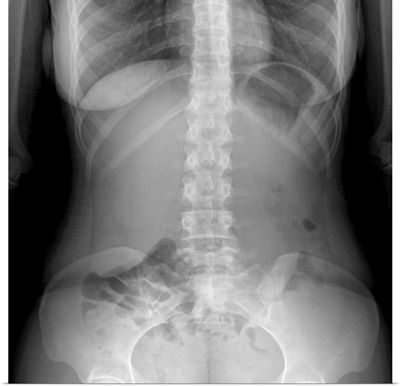 Normal abdomen, X-ray