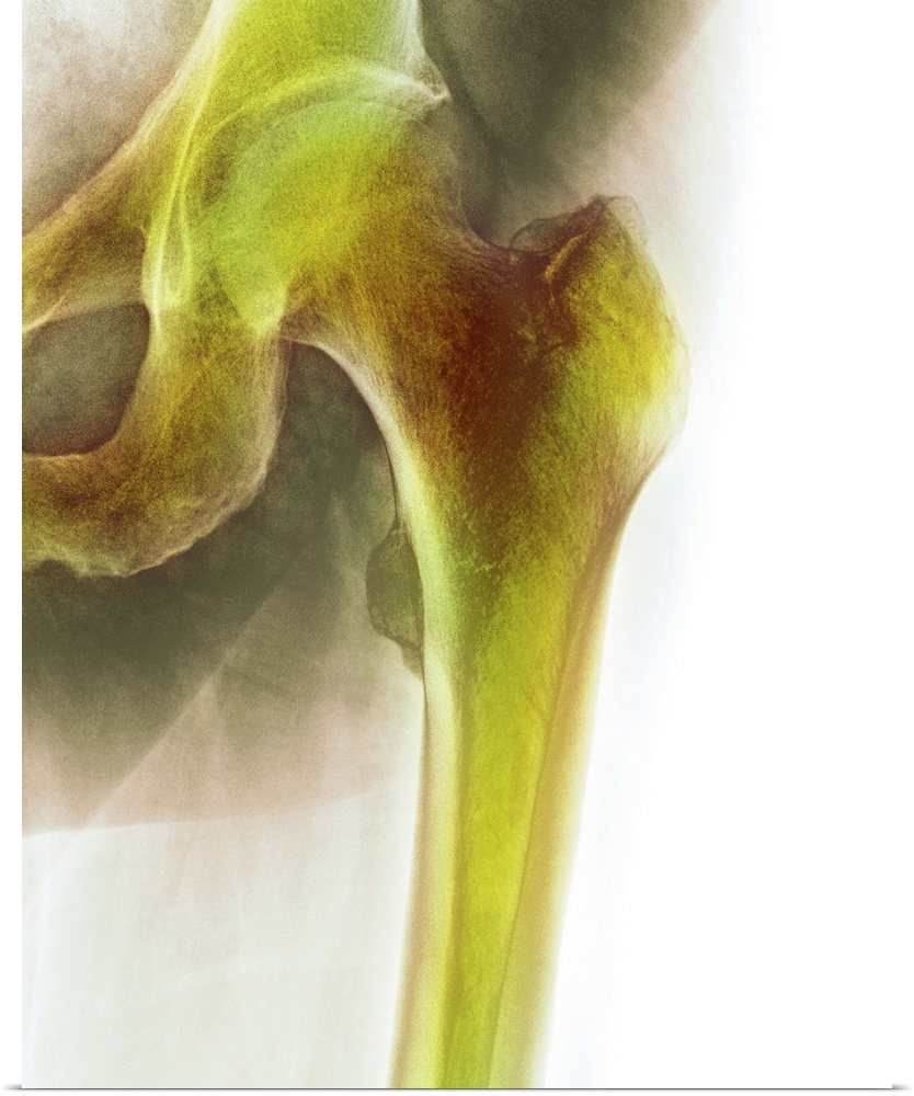 Normal hip. Coloured X-ray of the hip of a 90 year old man.
