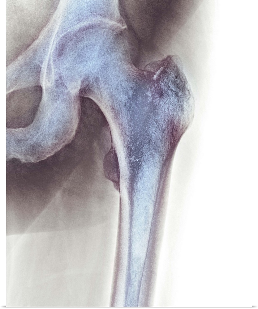 Normal hip. Coloured X-ray of the hip of a 90 year old man.