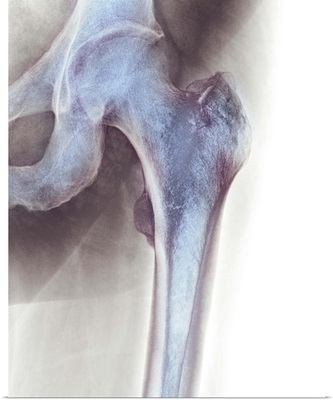 Normal hip, X-ray