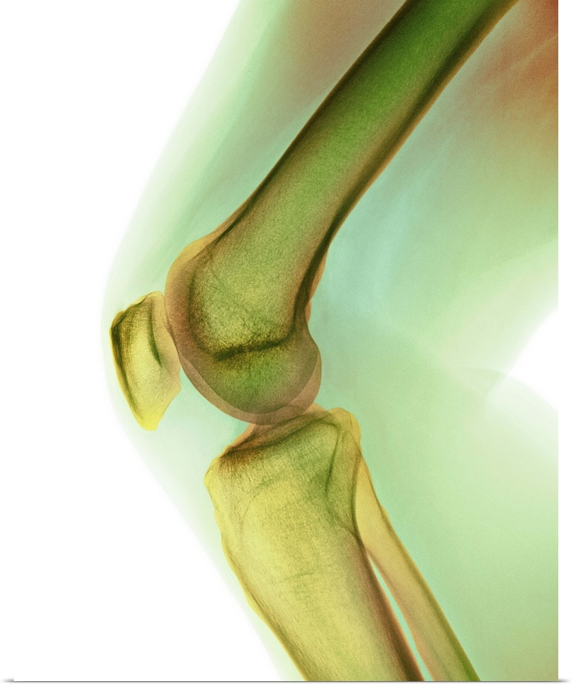 Normal knee. Coloured X-ray of the knee of a 44 year old woman.