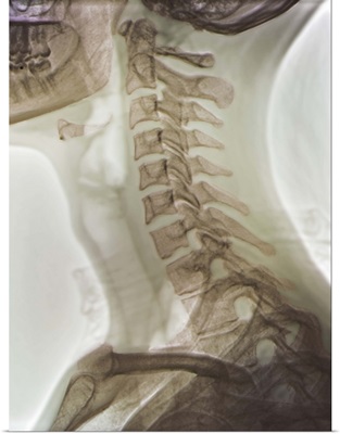 Normal neck, X-ray