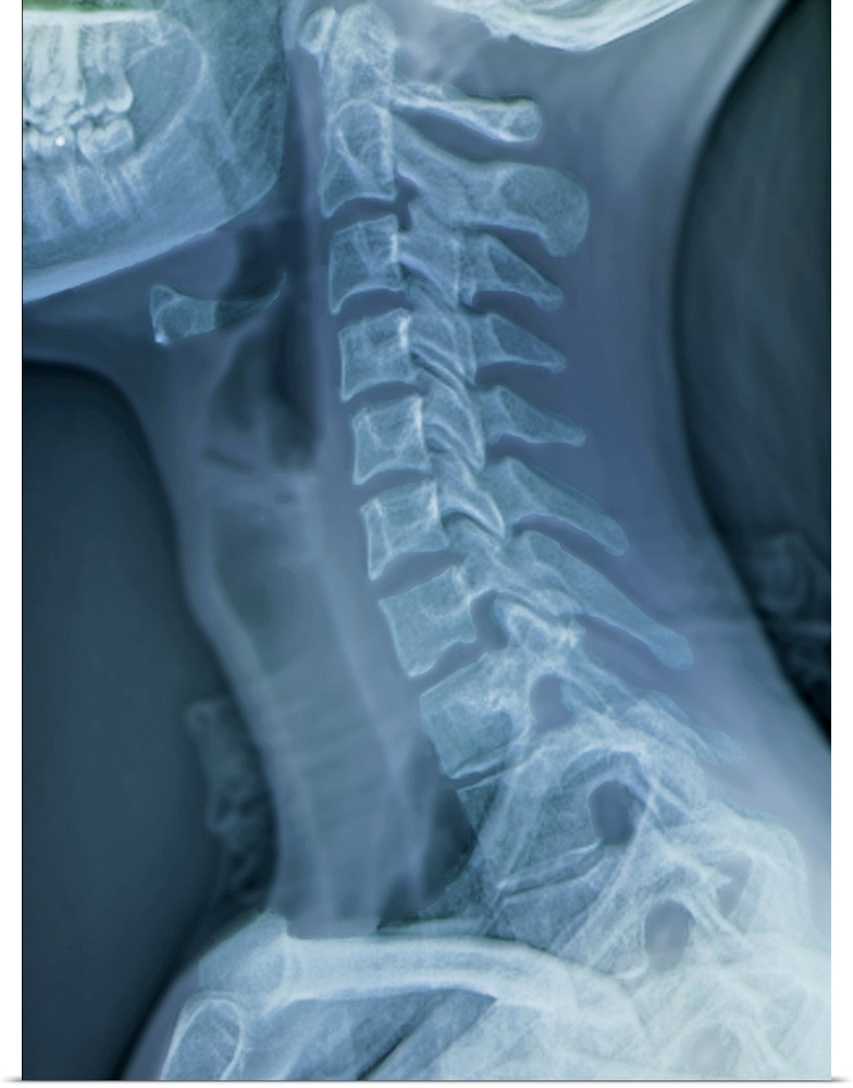 Normal neck. Coloured X-ray of the cervical spine of a 27 year old.