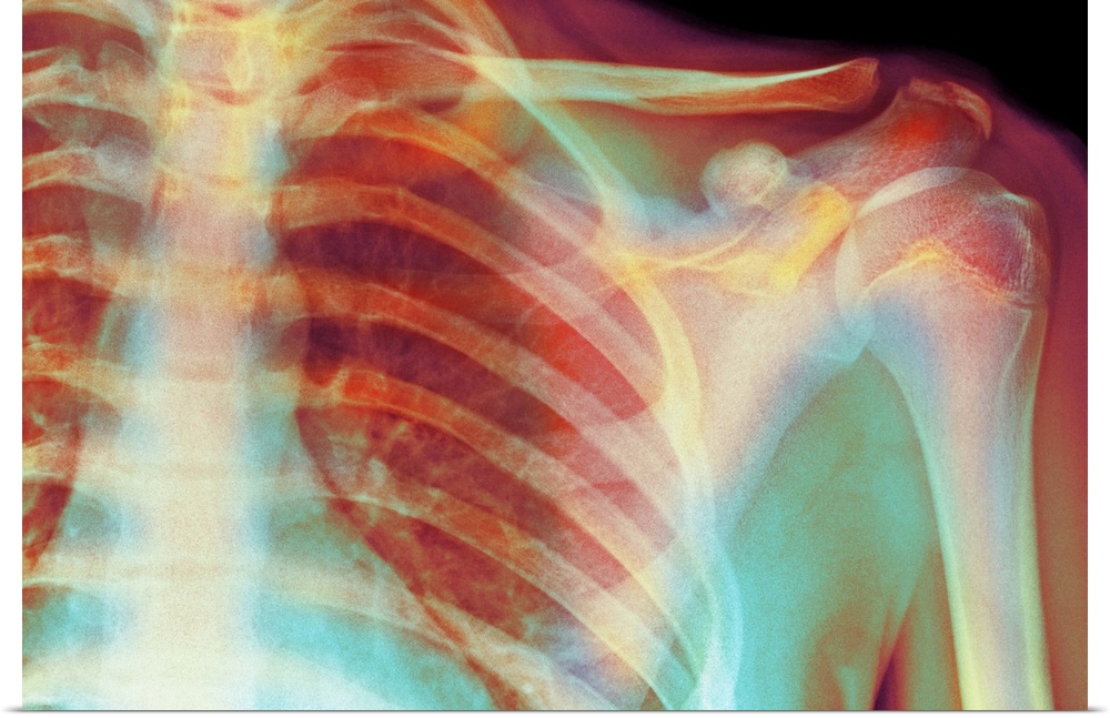 Normal shoulder. Coloured X-ray of the shoulder of a 19 year old man.