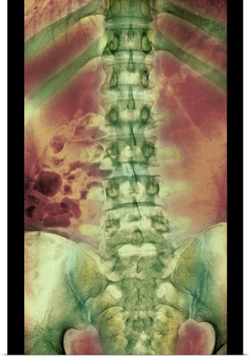 Normal spine, X-ray