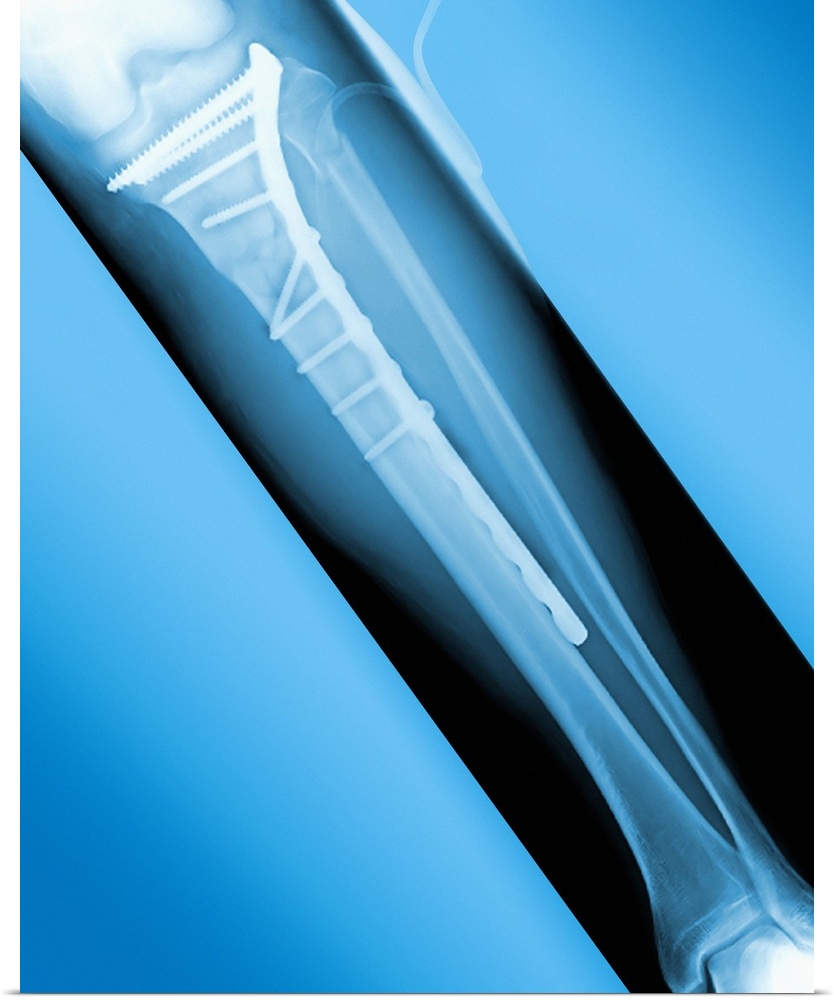 Pinned broken leg. Coloured X-ray of a metal plate and screws in a fractured tibia (shin bone).