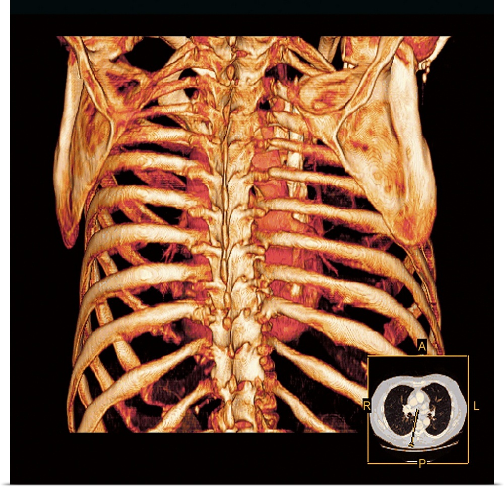 Rib cage. Coloured three-dimensional computed tomography (CT) scan of a posterior view of a healthy rib cage and heart.