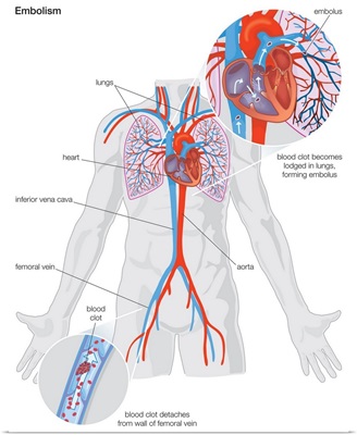 Arterial embolism