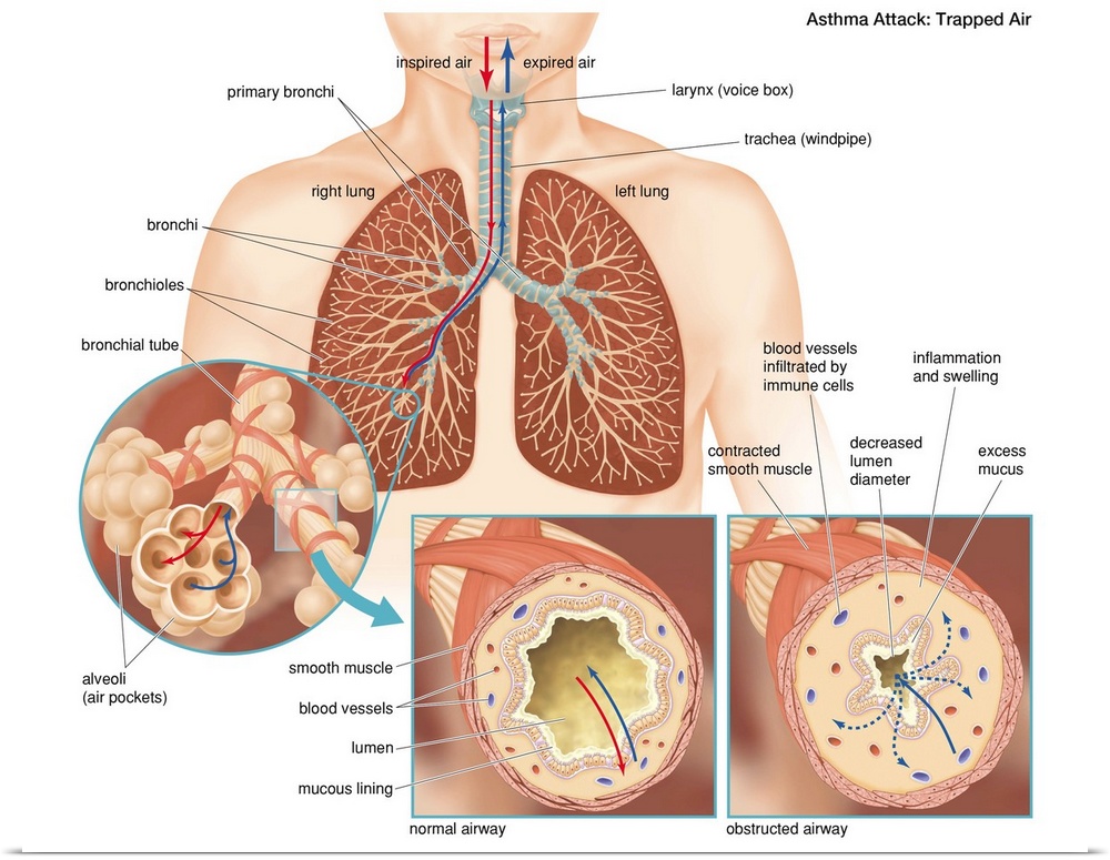 Coronary Artery Bypass