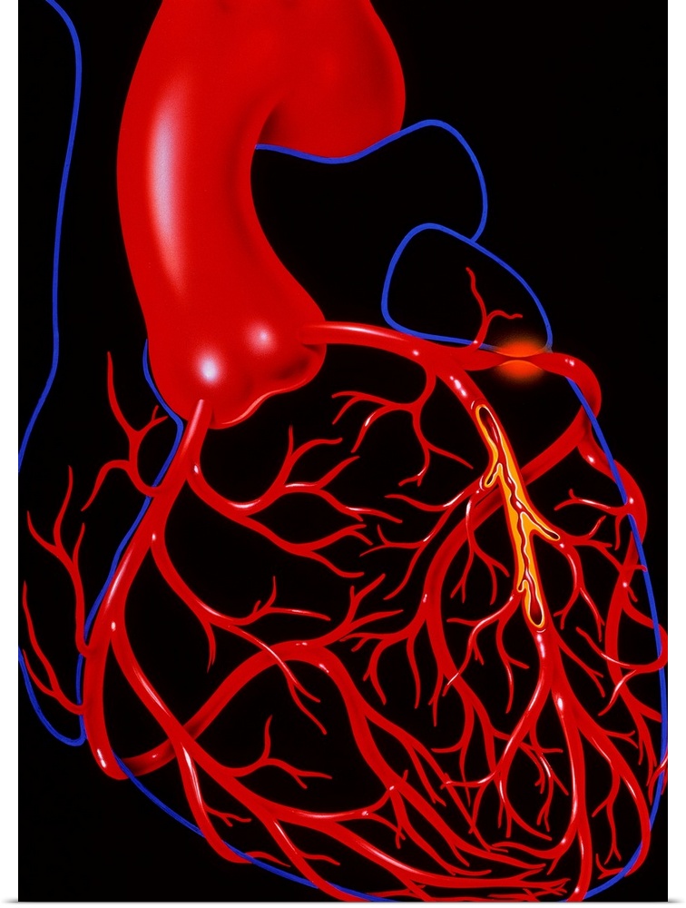Angina pectoris. Illustration of a heart diseased with the cardiac condition angina pectoris. The heart is outlined in blu...