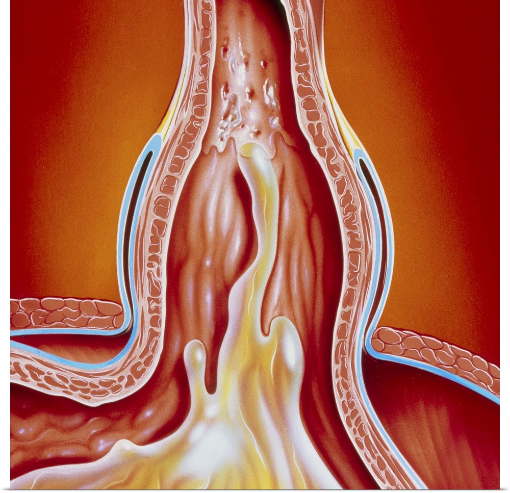 Hiatus hernia. Illustration of a hiatus hernia, showing gastro-oesophageal reflux. Here, the junction between the oesophag...