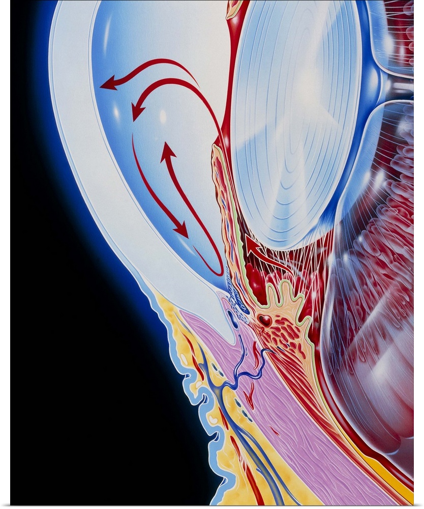 Glaucoma. Illustration showing flow of aqueous humour (red arrows) in the eye in glaucoma. Aqueous humour is fluid produce...