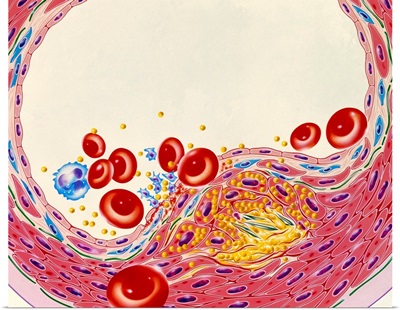 Artwork of artery narrowed by atherosclerosis