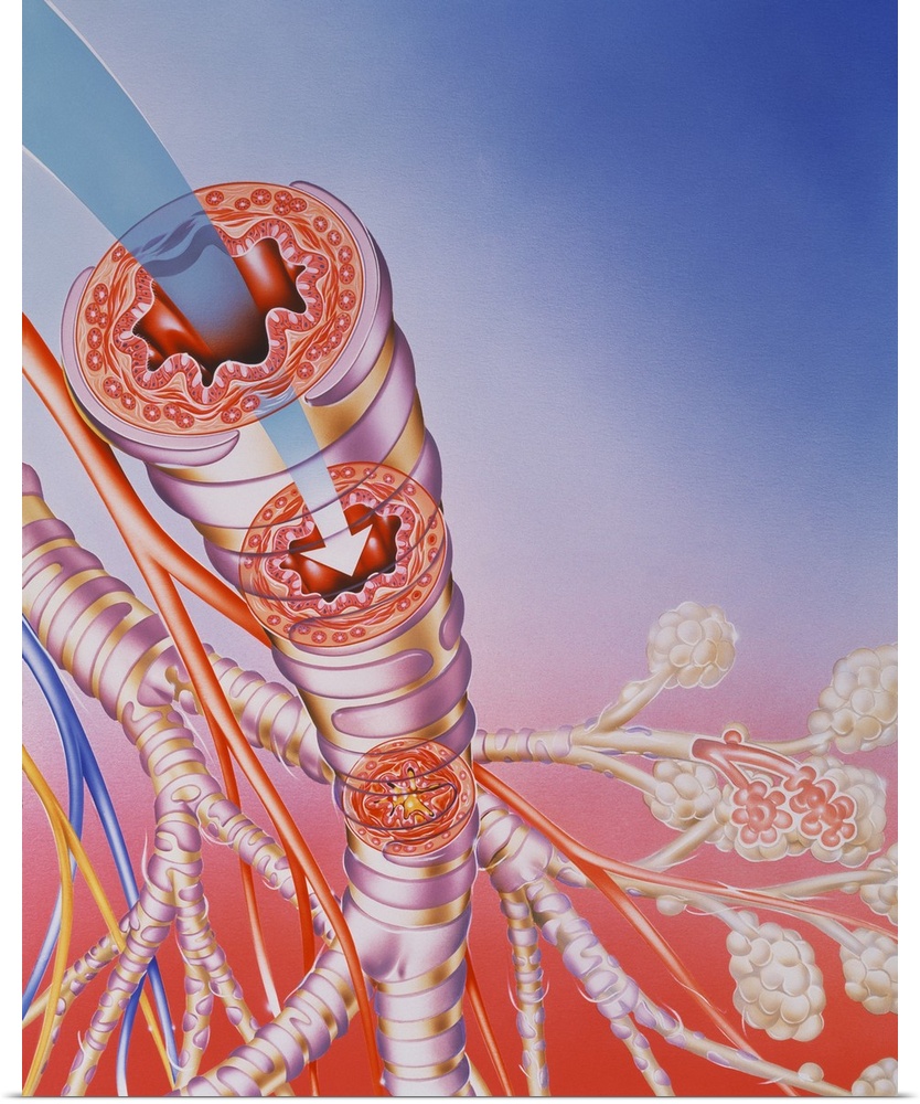 Asthma treatment. Artwork showing the action of a bronchodilator drug breathed into the respiratory system from an aerosol...