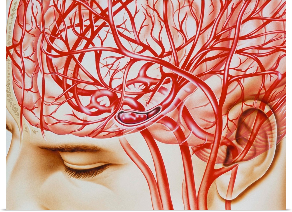 Cerebral embolism. Artwork of the blood supply to the head showing an embolism (blockage) in the cerebral artery, a cause ...