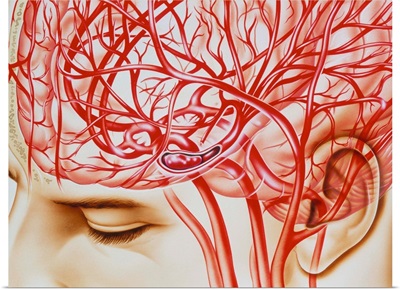 Artwork of cerebral embolism, cause of stroke