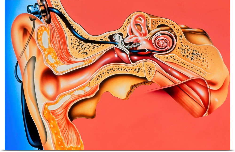 Cochlear implant. Illustration of a cochlear implant in a human ear. This device transmits electrical impulses directly to...