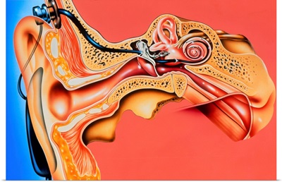 Artwork of cochlear implant in ear