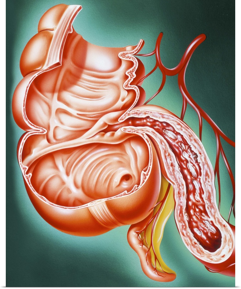 Crohn's disease. Artwork of a section through part of the human digestive tract, showing the small intestine affected by C...
