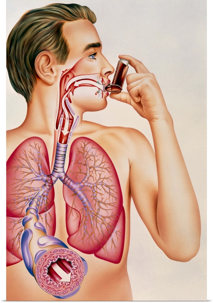 Asthma inhaler. Artwork showing the effects of an asthma inhaler containing bronchodilator drugs on the lungs of a man. Br...