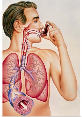 Artwork of effects of asthma inhaler on man's lung