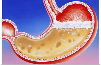 Artwork of heartburn (acid indigestion) in stomach