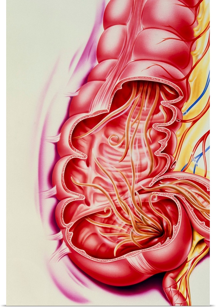 Ascaris nematode worms. Artwork of the human intestines cutaway to reveal Ascaris lumbricoides nematode worms (threadworms...