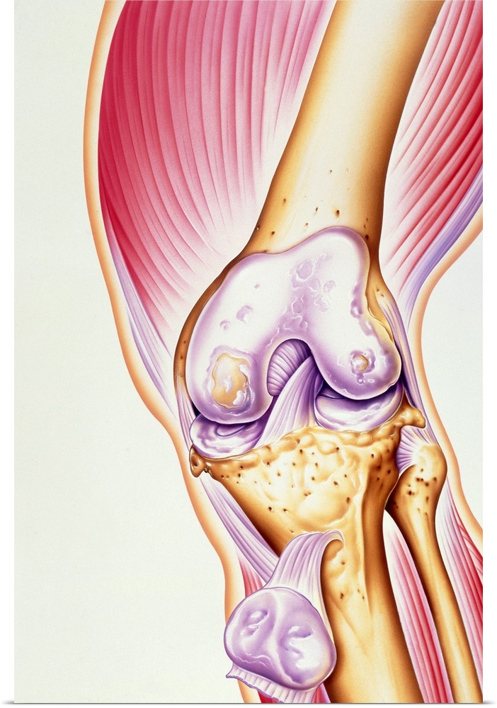 Osteoarthritis of knee. Illustration of the joint of a human knee affected by osteoarthritis. The cartilage (purple) at th...