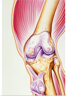 Artwork of osteoarthritis of knee joint