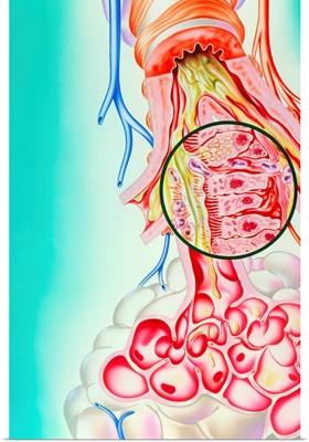 Artwork of the respiratory system of an asthmatic